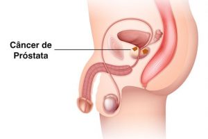 Imagem da notícia - Novembro Azul: Número de casos de câncer de próstata preocupa especialistas